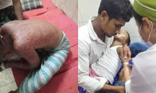 ময়মনসিংহে ভিমরুলের কামড়ে বাবা-মেয়ের পর ছেলেরও মৃত্যু